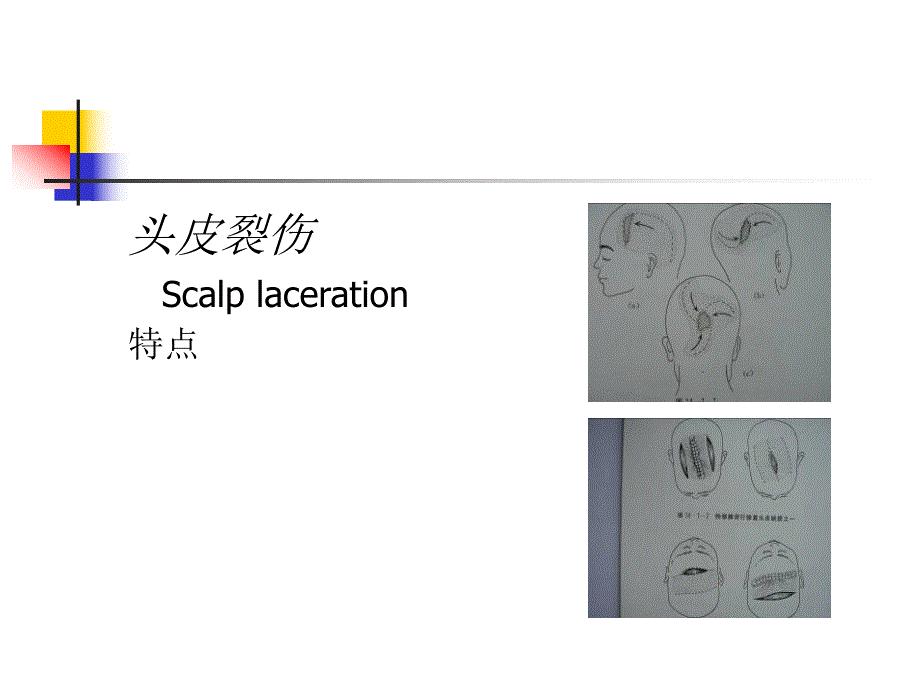 颅脑损伤教学幻灯片.ppt_第3页