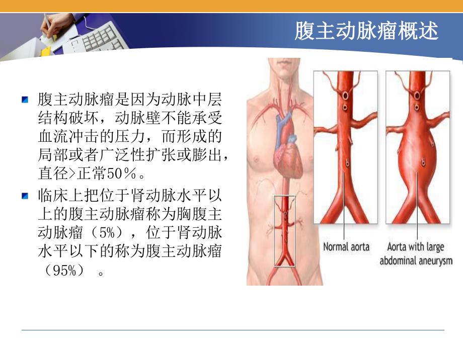 腹主动脉瘤的护理..ppt_第3页