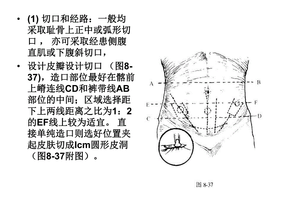 输尿管皮肤造瘘术.ppt_第2页