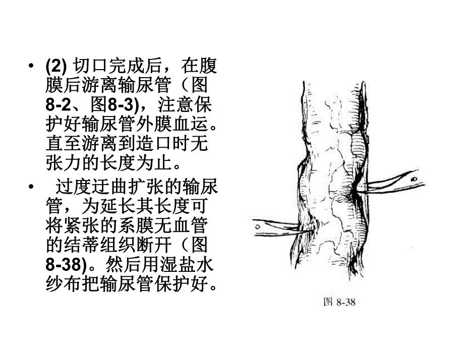 输尿管皮肤造瘘术.ppt_第3页