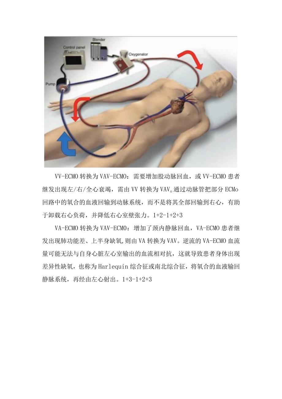 临床ECMO基本工作原理、工作模式及护理观察要点.docx_第3页