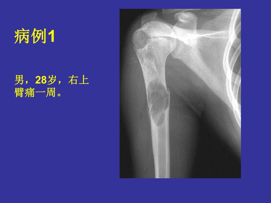 骨骼囊性病变.ppt_第3页