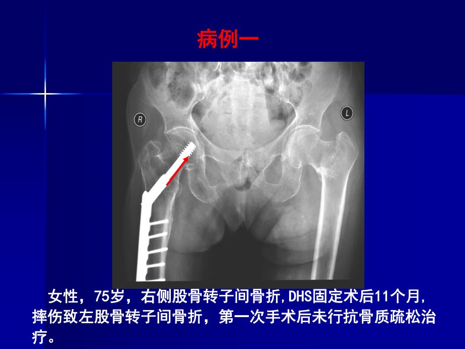 骨质疏松症诊断与防治.ppt_第3页