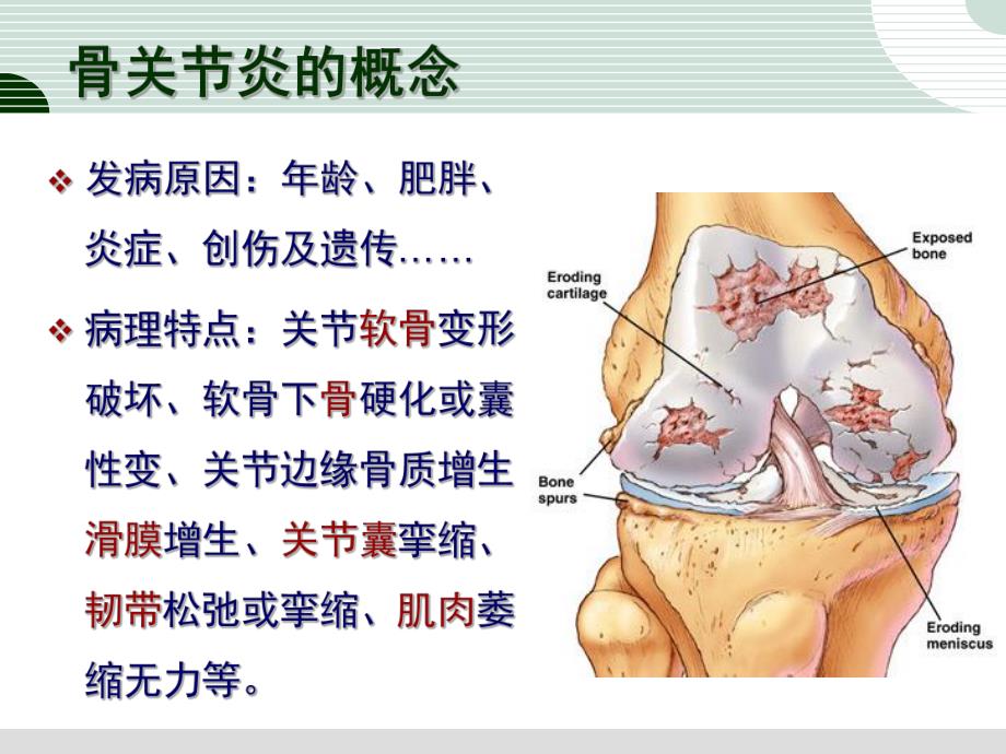 骨关节炎的诊治.ppt_第3页