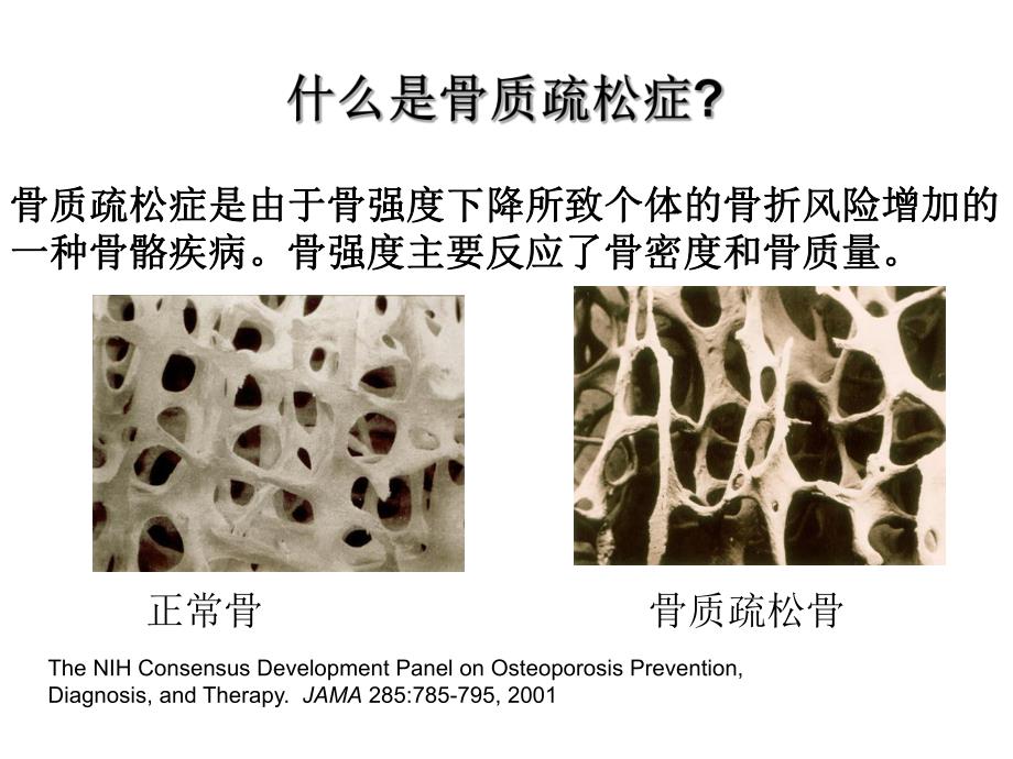 骨质疏松疾病、预防、治疗.ppt_第2页