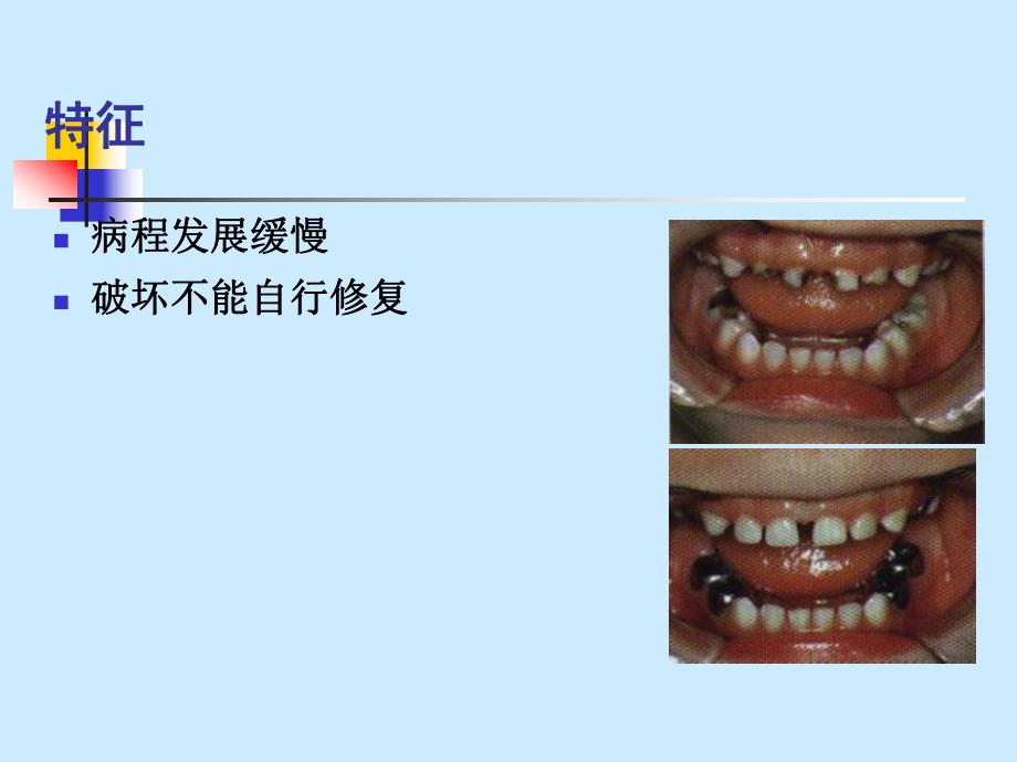 龋病病因、临床表现、诊断、鉴别诊断.ppt_第3页