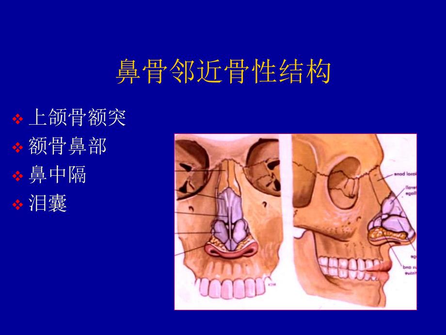 鼻骨骨折影像学诊断.ppt_第3页