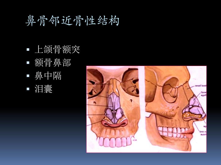 鼻骨骨折影像学诊断与鉴别.ppt_第3页