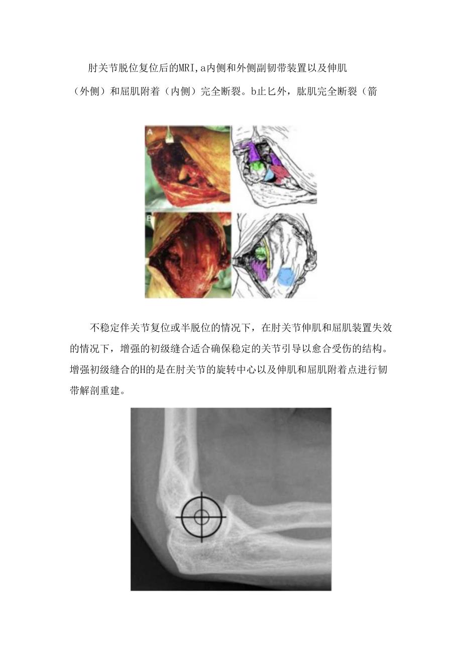 单纯肘关节脱位定义、临床表现及治疗要点.docx_第2页