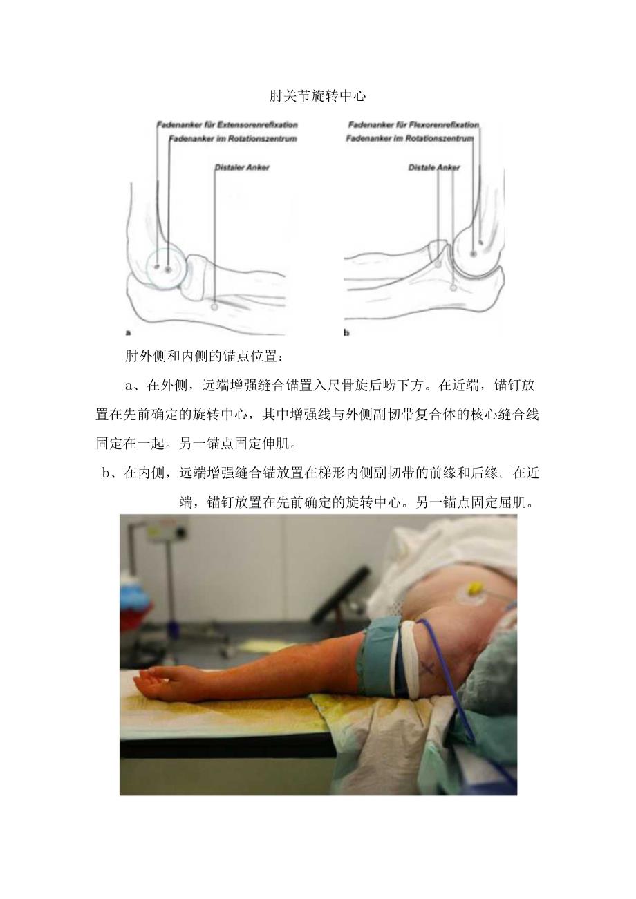 单纯肘关节脱位定义、临床表现及治疗要点.docx_第3页