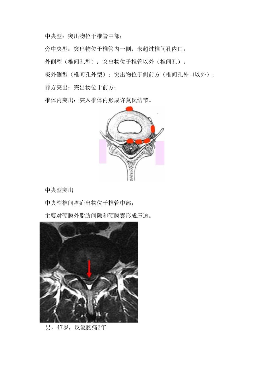 正常椎间盘结构椎间盘突出分型影像特征.docx_第2页