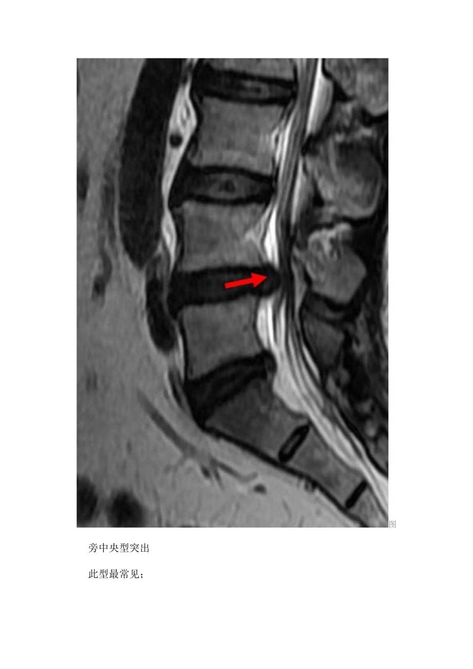 正常椎间盘结构椎间盘突出分型影像特征.docx_第3页