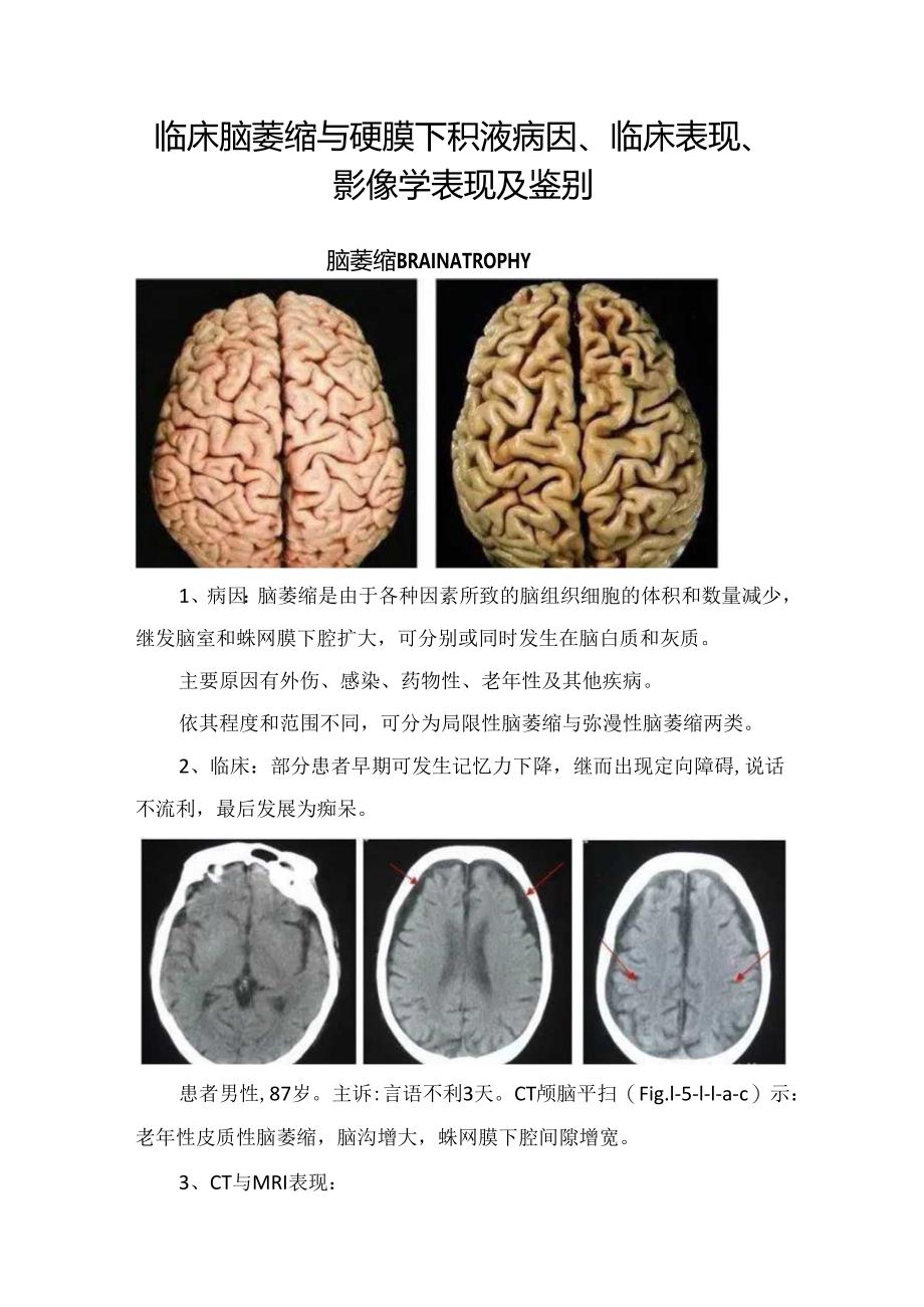 临床脑萎缩与硬膜下积液病因、临床表现、影像学表现及鉴别.docx_第1页