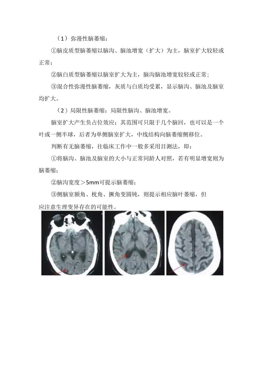 临床脑萎缩与硬膜下积液病因、临床表现、影像学表现及鉴别.docx_第2页