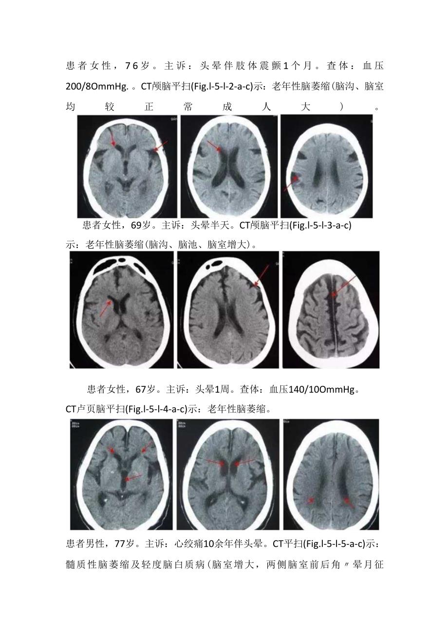 临床脑萎缩与硬膜下积液病因、临床表现、影像学表现及鉴别.docx_第3页