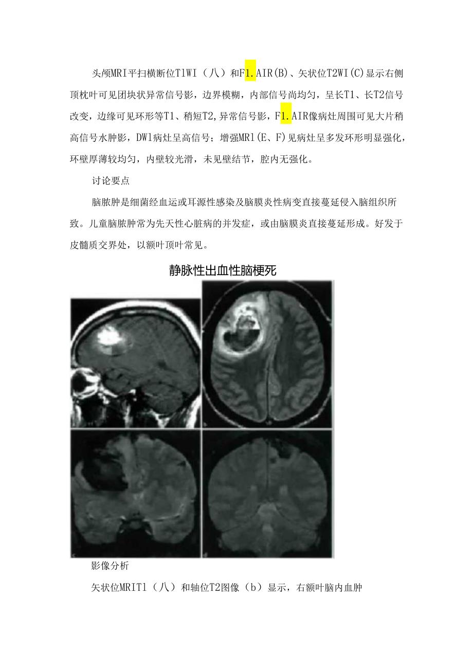 临床脑脓肿、静脉性出血性脑梗死、眼肌麻痹性偏头痛等头痛类型影像学表现、临床表现、影像鉴别及分析.docx_第2页