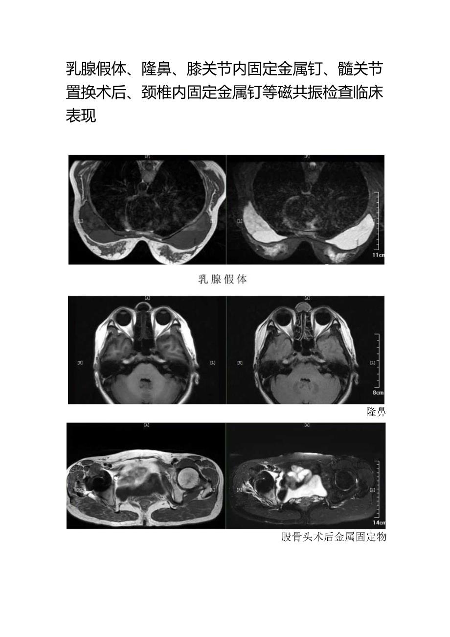 乳腺假体、隆鼻、膝关节内固定金属钉、髋关节置换术后、颈椎内固定金属钉等磁共振检查临床表现.docx_第1页