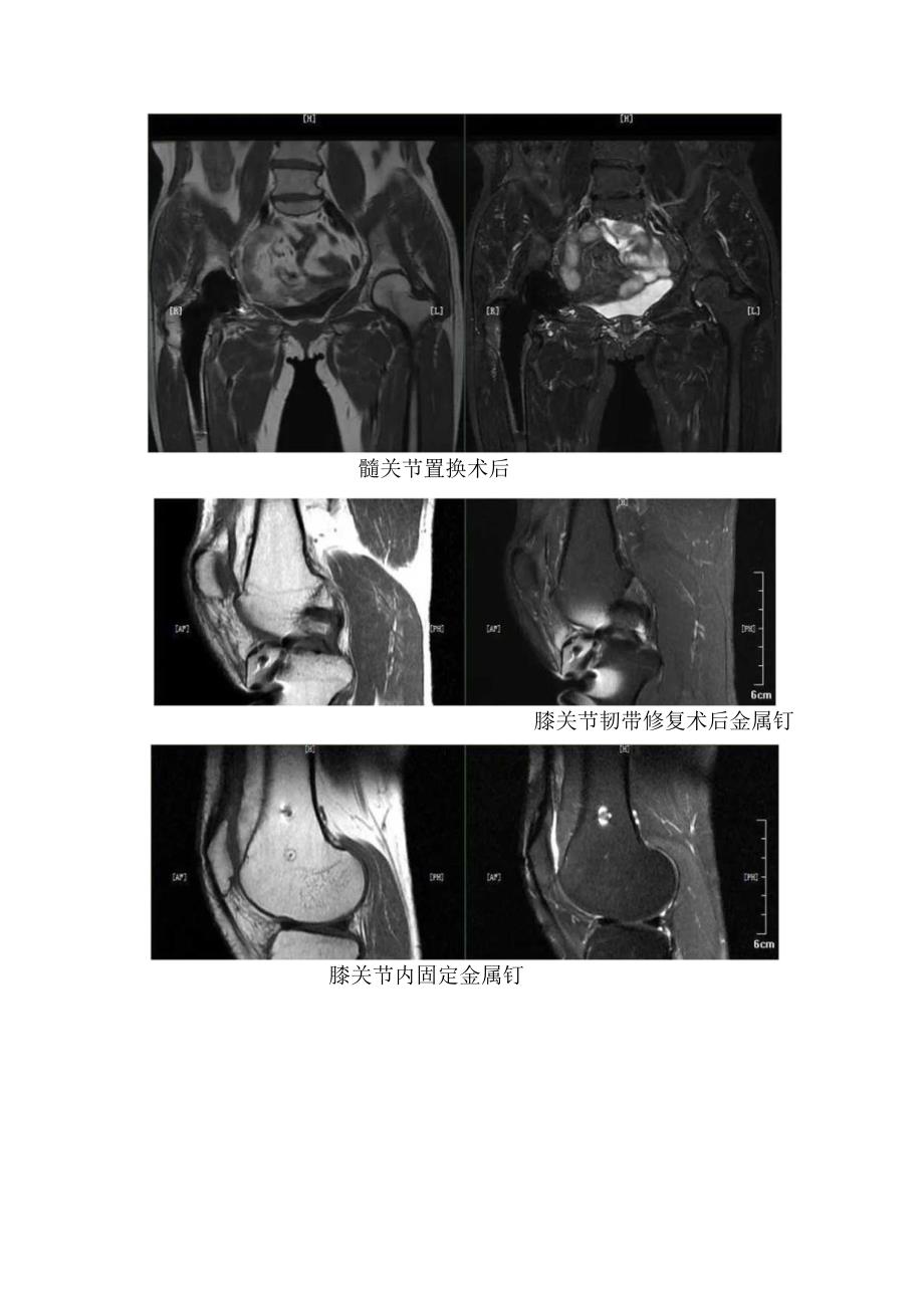 乳腺假体、隆鼻、膝关节内固定金属钉、髋关节置换术后、颈椎内固定金属钉等磁共振检查临床表现.docx_第2页