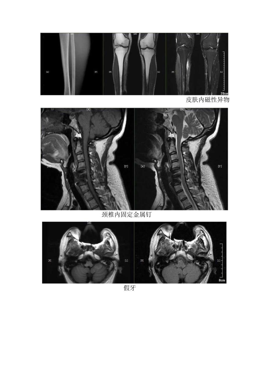 乳腺假体、隆鼻、膝关节内固定金属钉、髋关节置换术后、颈椎内固定金属钉等磁共振检查临床表现.docx_第3页