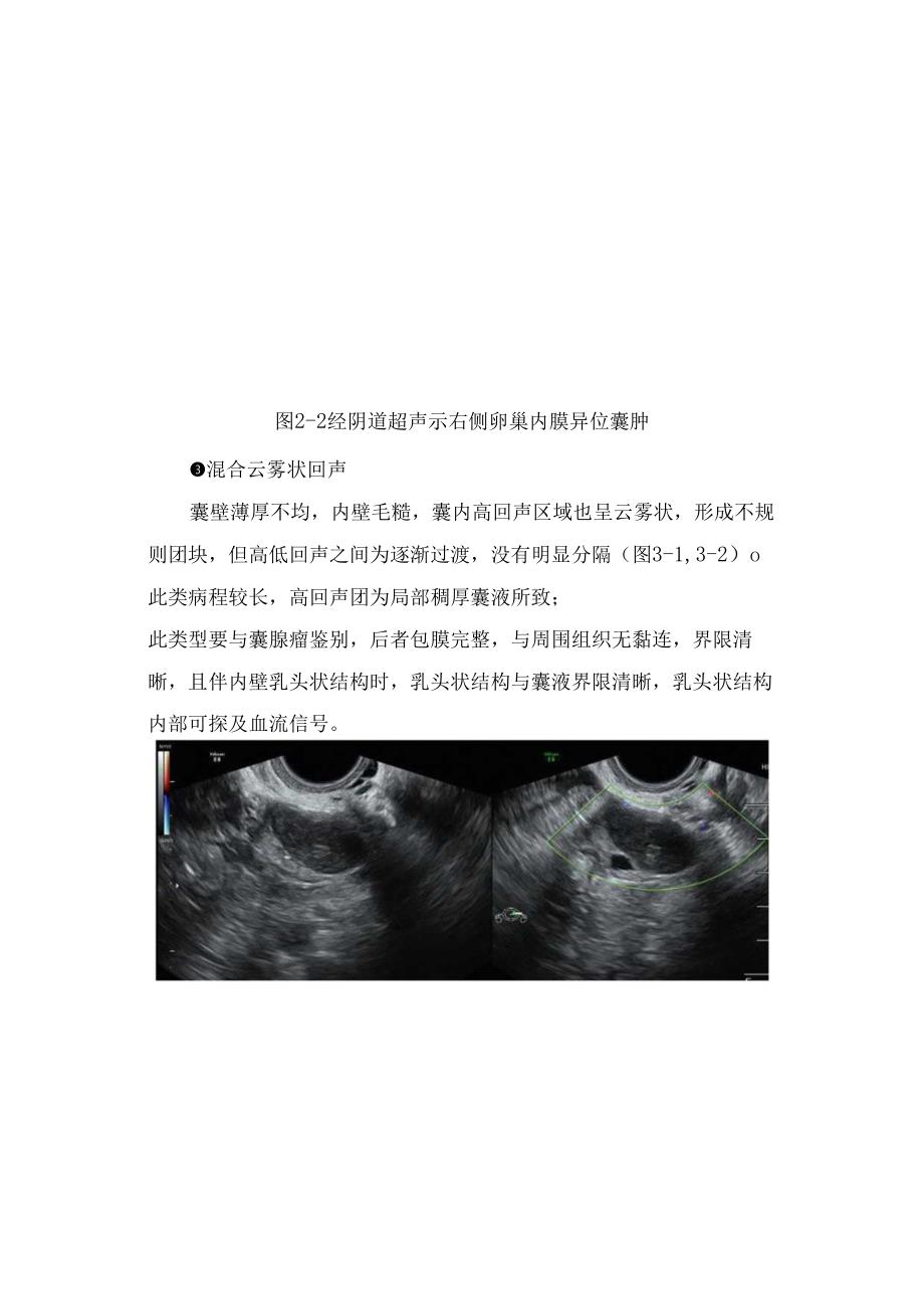 临床卵巢内膜异位囊肿超声表现.docx_第3页