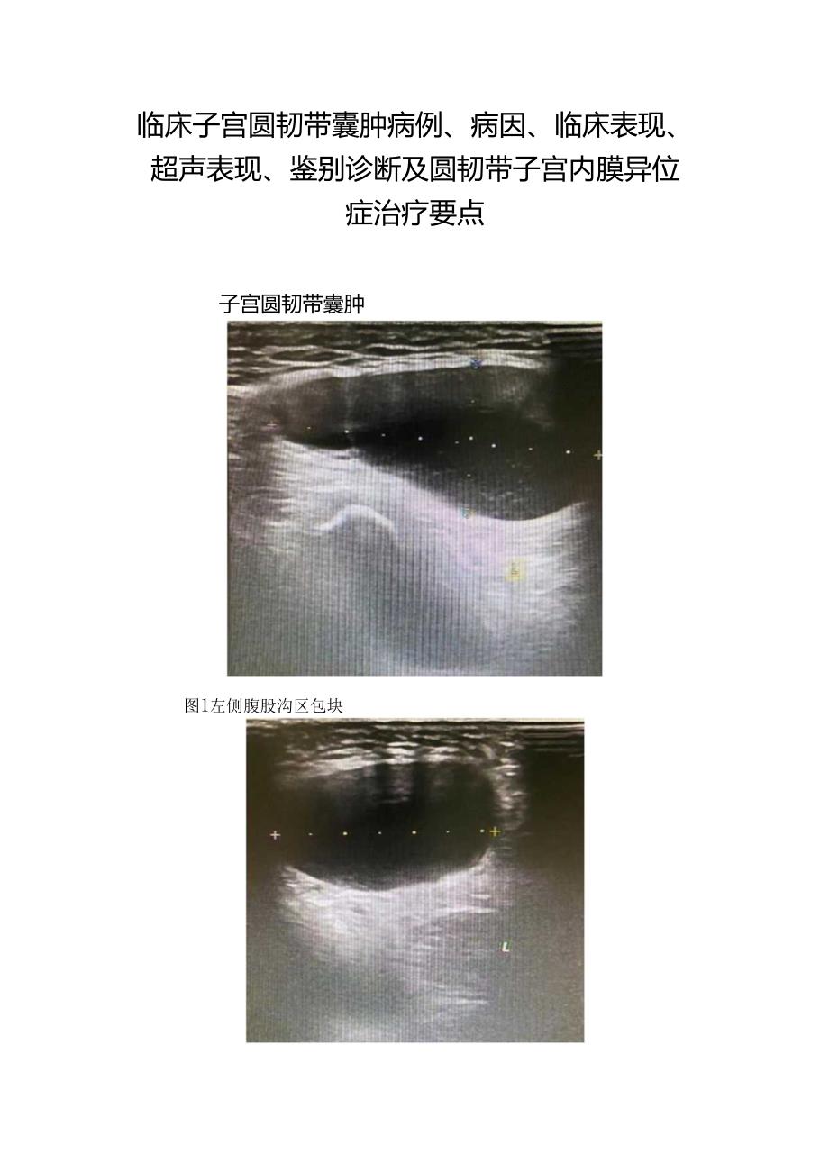 临床子宫圆韧带囊肿病例、病因、临床表现、超声表现、鉴别诊断及圆韧带子宫内膜异位症治疗要点.docx_第1页