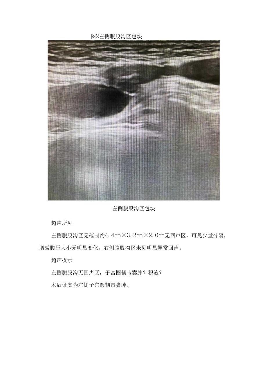 临床子宫圆韧带囊肿病例、病因、临床表现、超声表现、鉴别诊断及圆韧带子宫内膜异位症治疗要点.docx_第2页