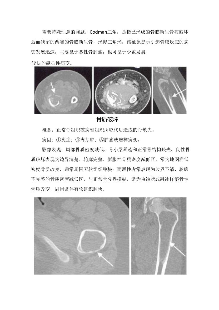 临床骨质疏松、骨膜反应、骨质破坏、骨质增生硬化、骨质坏死、软骨钙化等骨基本病变概念、病因及注意问题.docx_第3页