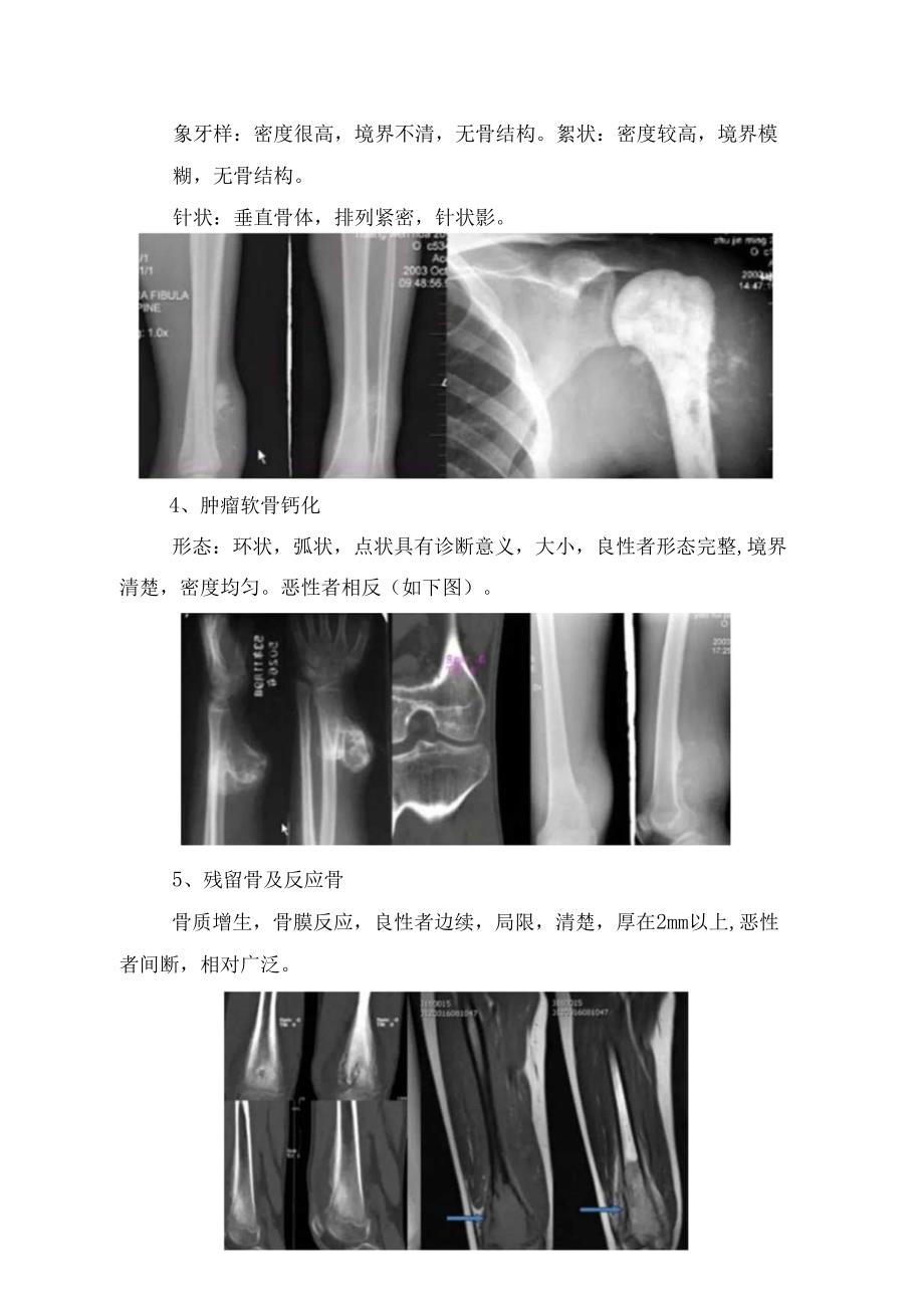 临床骨肿瘤病理、肿瘤判断、良恶性肿瘤判断及注意要点.docx_第3页