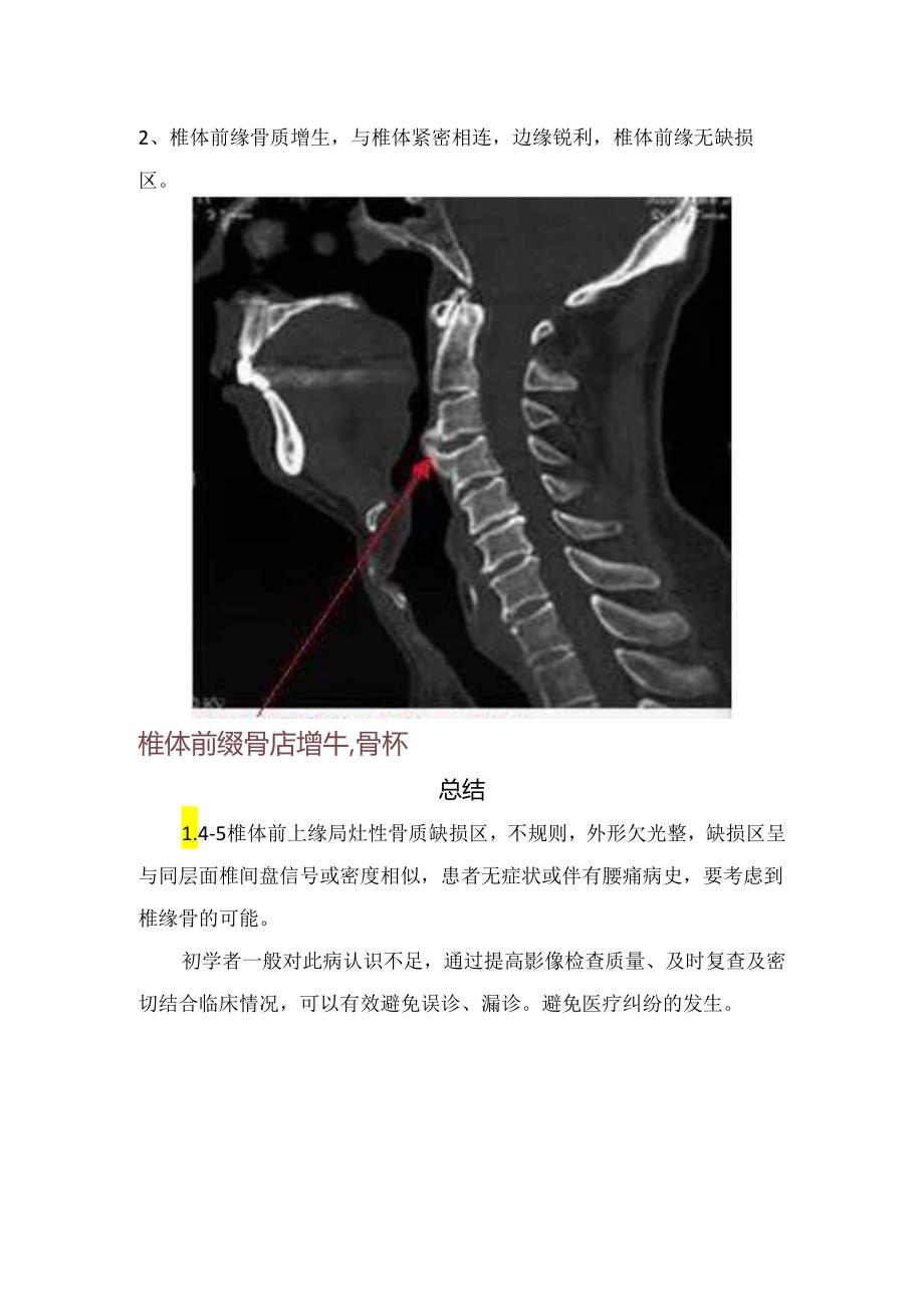 临床椎缘骨介绍、示意图、影像学表现、发病机制及与体前缘骨折、椎体前缘骨质增生等疾病区别.docx_第3页