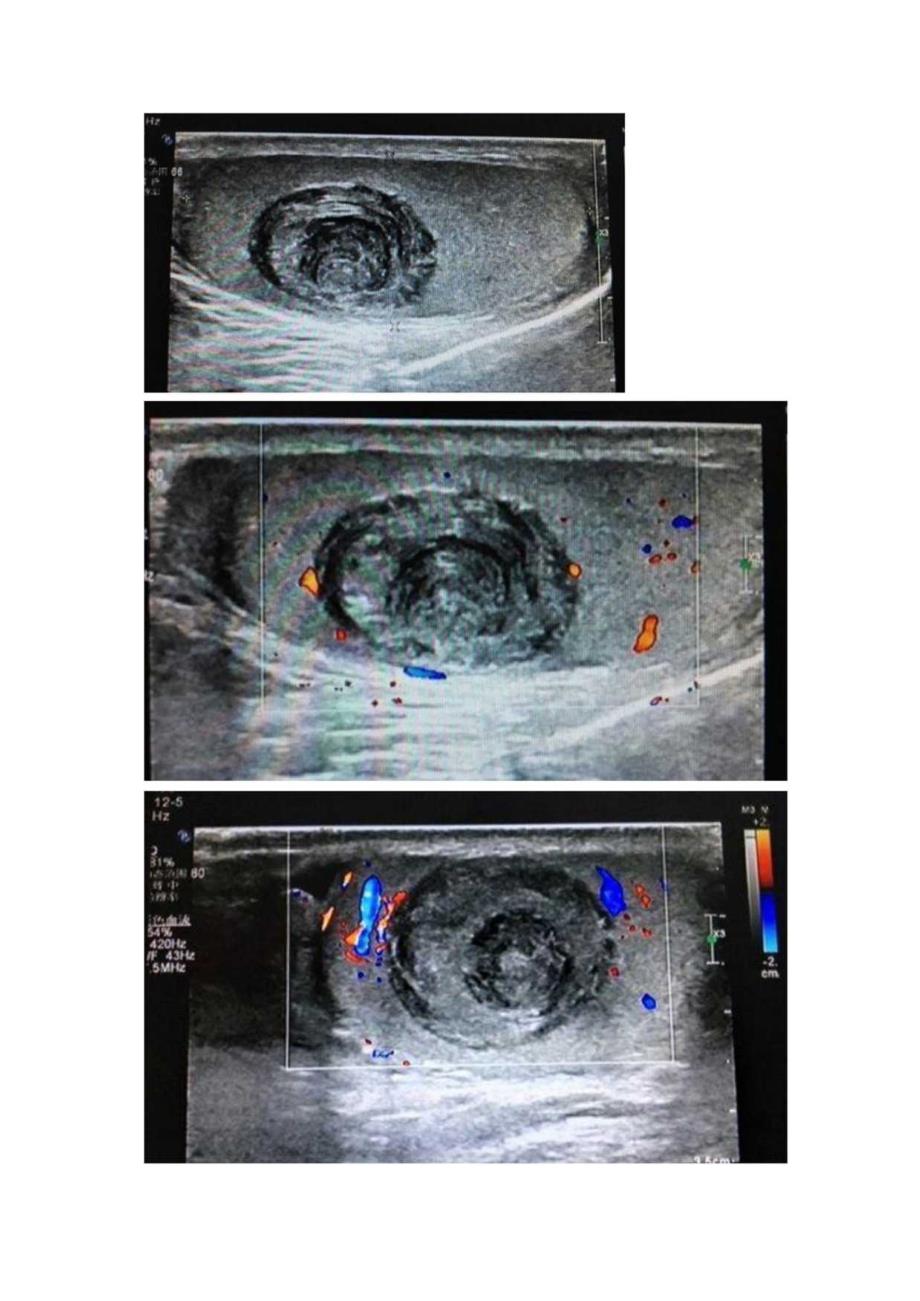 临床睾丸表皮样囊肿、皮肤表皮样囊肿、腹腔粘液包块等超声洋葱皮螺纹征临床表现及影像学特征.docx_第2页