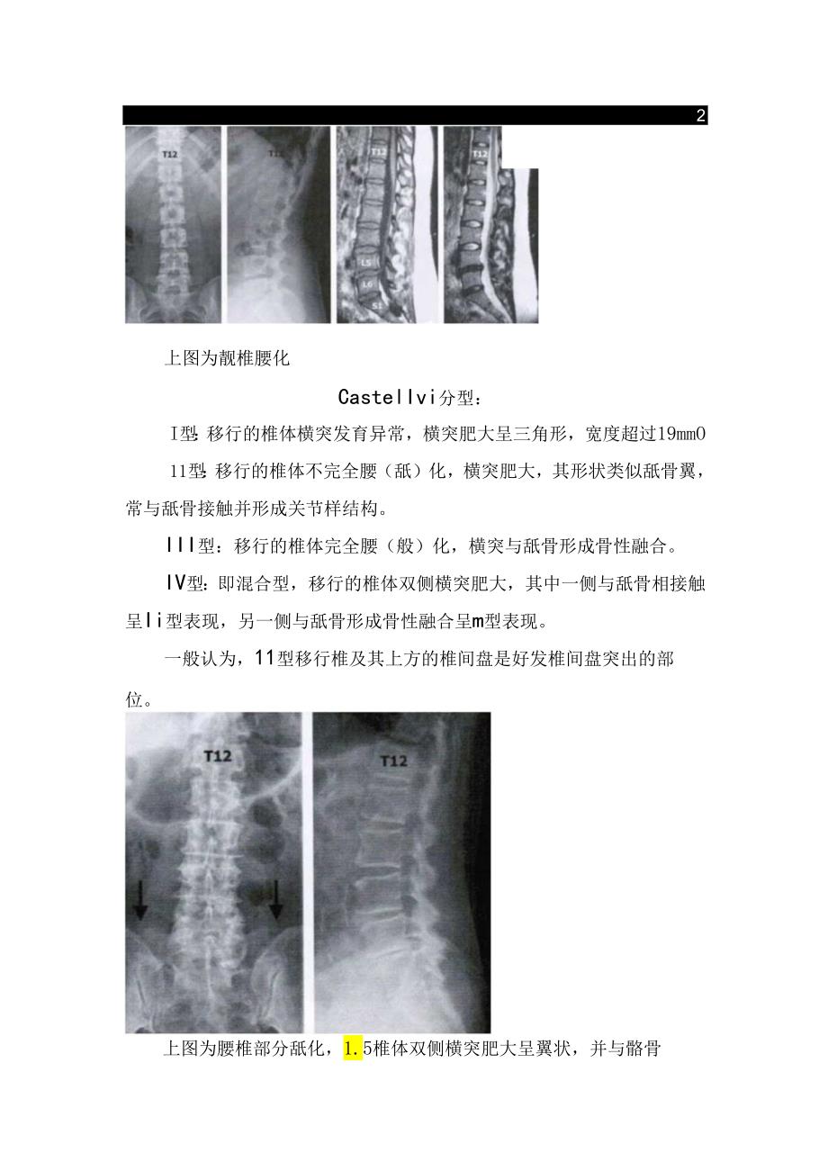 腰骶部移行椎分型、临床表现及影像表现.docx_第2页