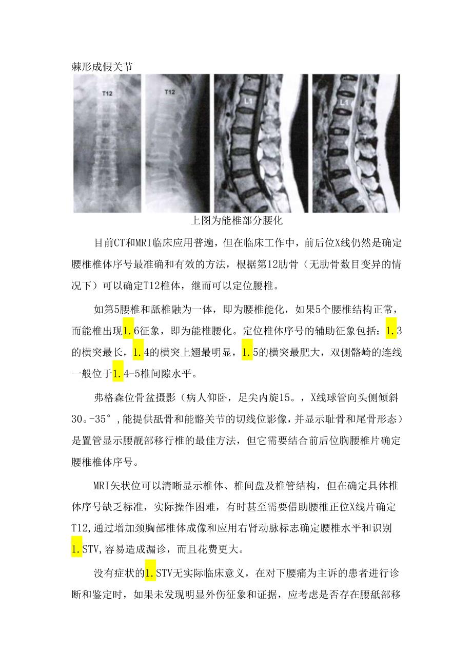 腰骶部移行椎分型、临床表现及影像表现.docx_第3页