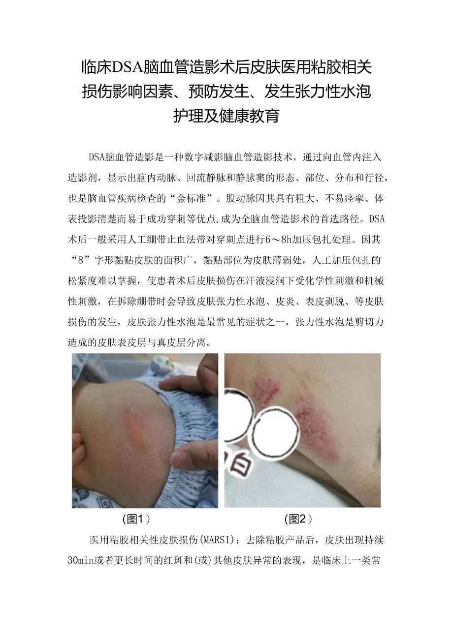 临床DSA脑血管造影术后皮肤医用粘胶相关损伤影响因素、预防发生、发生张力性水泡护理及健康教育.docx_第1页