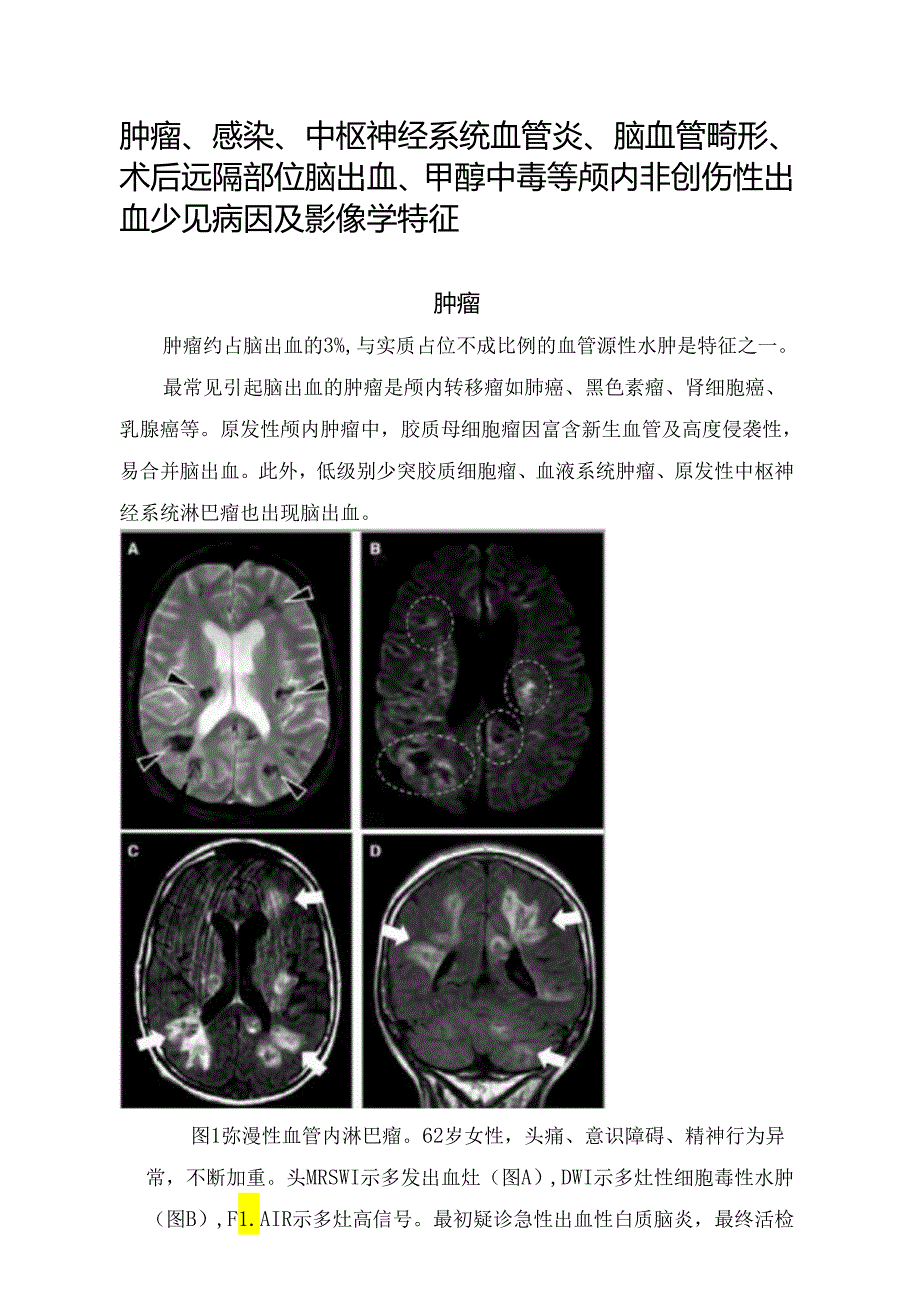 肿瘤、感染、中枢神经系统血管炎、脑血管畸形、术后远隔部位脑出血、甲醇中毒等颅内非创伤性出血少见病因及影像学特征.docx_第1页