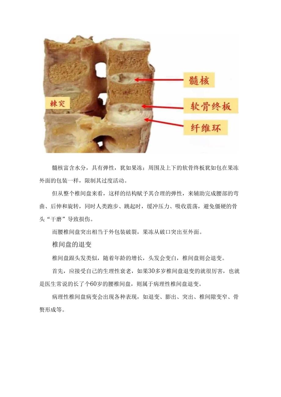 临床腰椎间盘突出症病理、结构、病变、影响下位神经根、临床表现、影像学表现、治疗及腰背部肌肉功能锻炼.docx_第2页