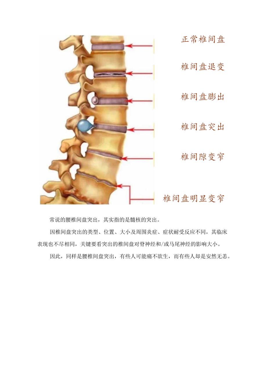 临床腰椎间盘突出症病理、结构、病变、影响下位神经根、临床表现、影像学表现、治疗及腰背部肌肉功能锻炼.docx_第3页