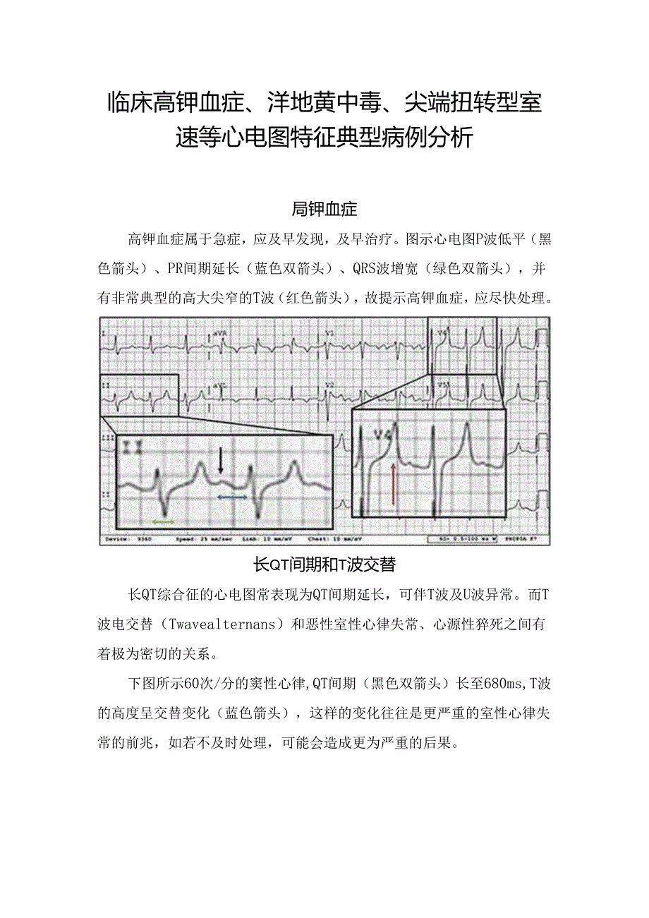 临床高钾血症、洋地黄中毒、尖端扭转型室速等心电图特征典型病例分析.docx_第1页