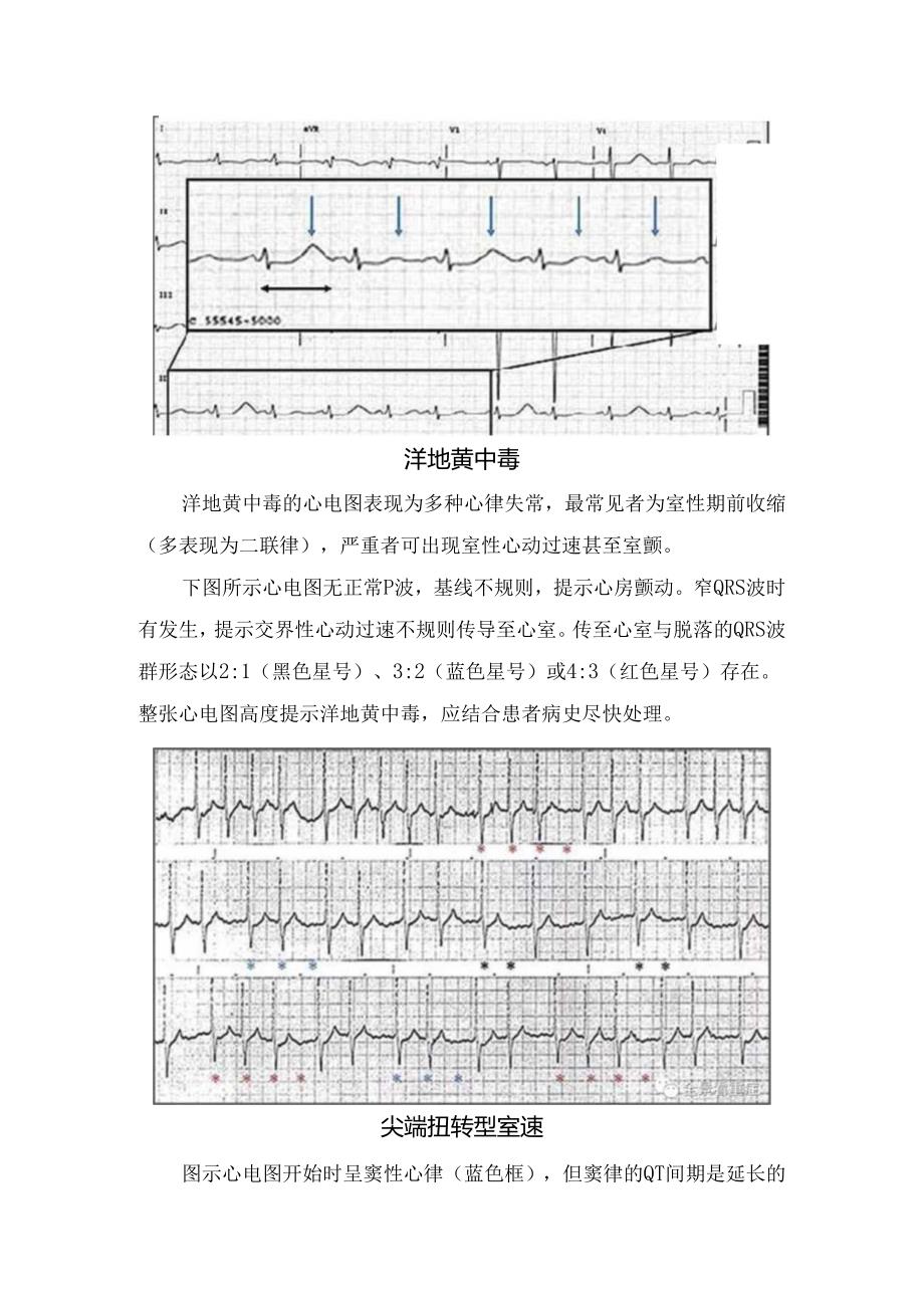 临床高钾血症、洋地黄中毒、尖端扭转型室速等心电图特征典型病例分析.docx_第2页