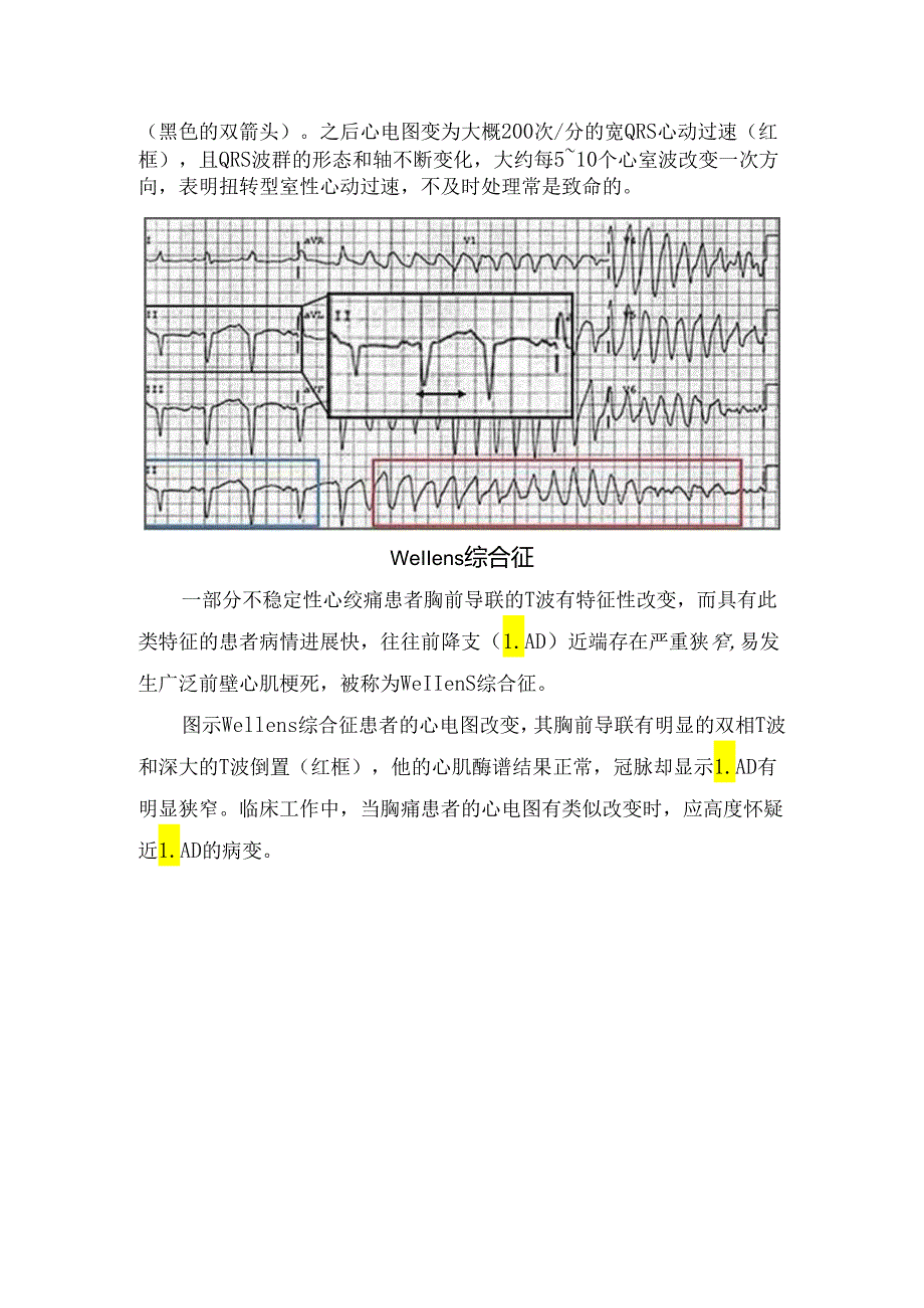 临床高钾血症、洋地黄中毒、尖端扭转型室速等心电图特征典型病例分析.docx_第3页