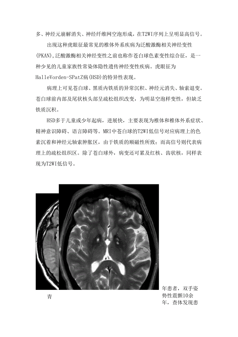 临床脑组织铁沉积性神经变性疾病虎眼征影像学征象、病理及疾病鉴别.docx_第2页