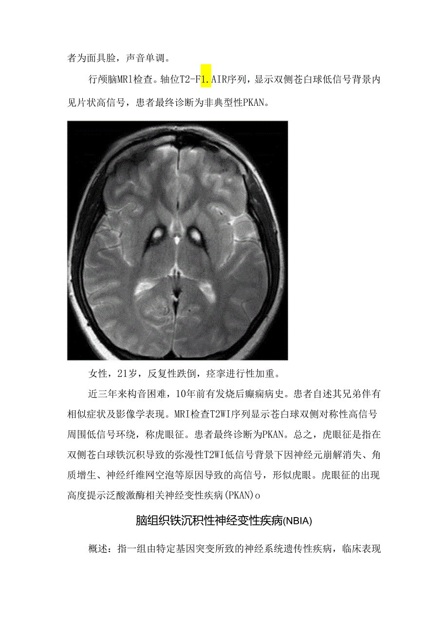 临床脑组织铁沉积性神经变性疾病虎眼征影像学征象、病理及疾病鉴别.docx_第3页