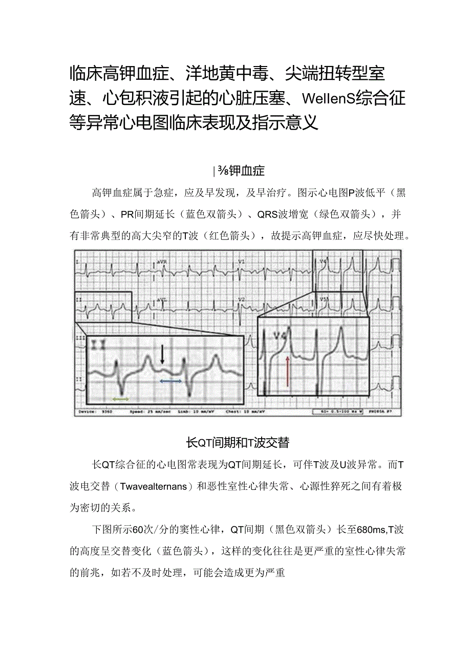 临床高钾血症、洋地黄中毒、尖端扭转型室速、心包积液引起的心脏压塞、Wellens综合征等异常心电图临床表现及指示意义.docx_第1页