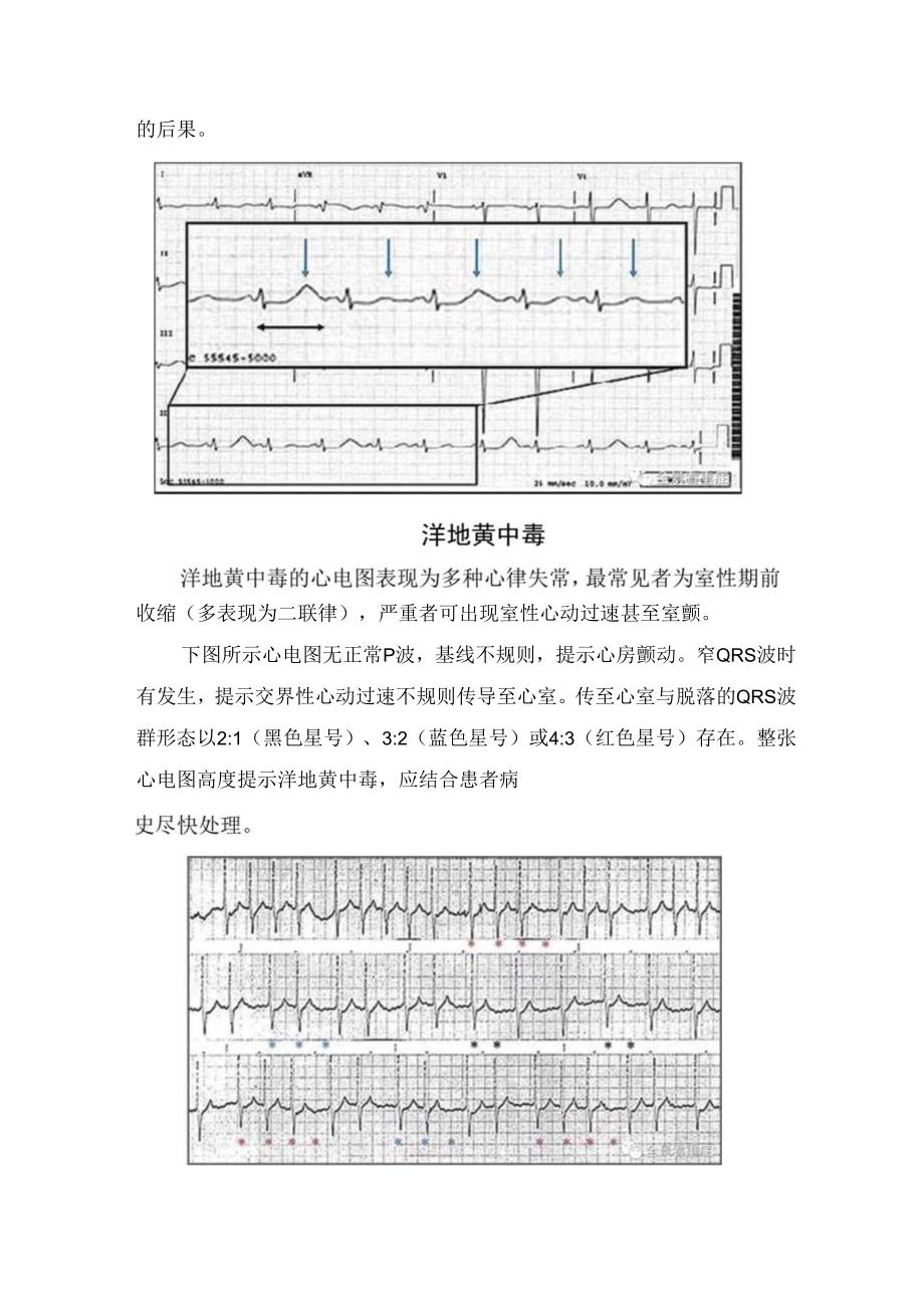 临床高钾血症、洋地黄中毒、尖端扭转型室速、心包积液引起的心脏压塞、Wellens综合征等异常心电图临床表现及指示意义.docx_第2页