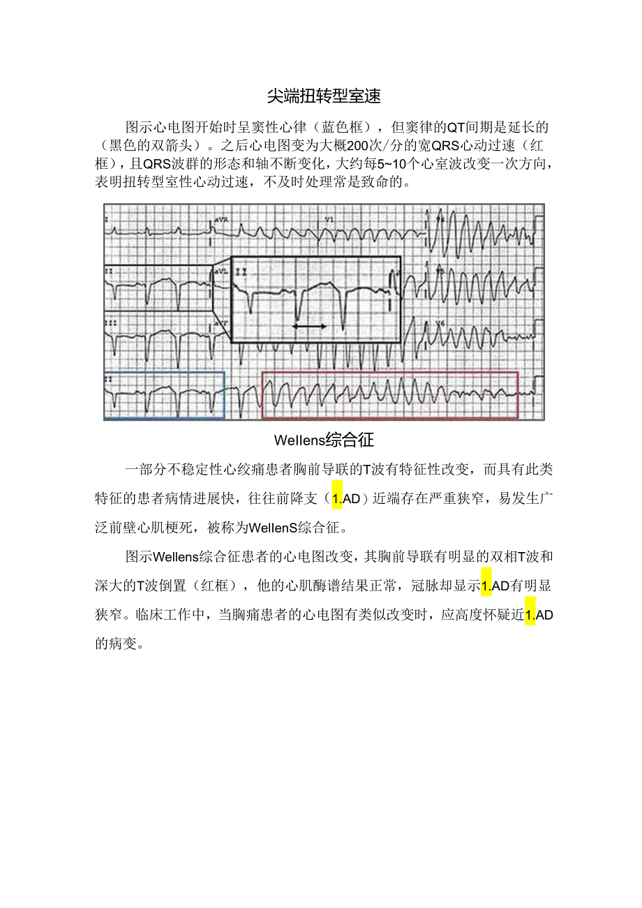 临床高钾血症、洋地黄中毒、尖端扭转型室速、心包积液引起的心脏压塞、Wellens综合征等异常心电图临床表现及指示意义.docx_第3页