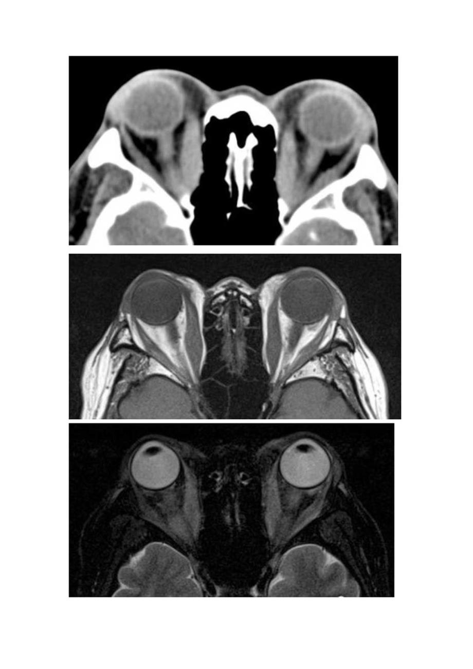 临床眼眶炎性假瘤病理、影像学表现及鉴别诊断.docx_第3页