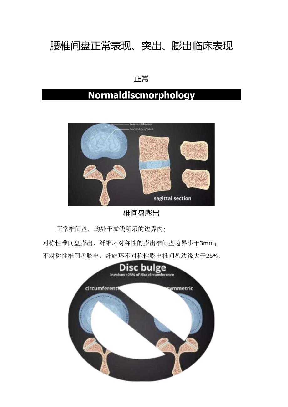 腰椎间盘正常表现、突出、膨出临床表现.docx_第1页