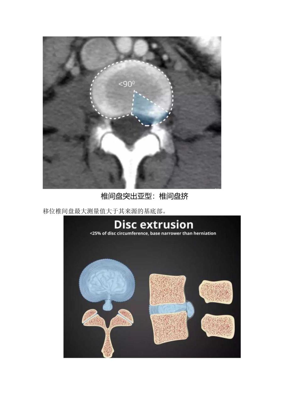 腰椎间盘正常表现、突出、膨出临床表现.docx_第3页