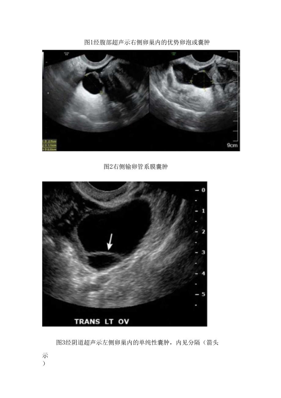 临床单纯性囊肿病理、超声表现及鉴别诊断.docx_第2页