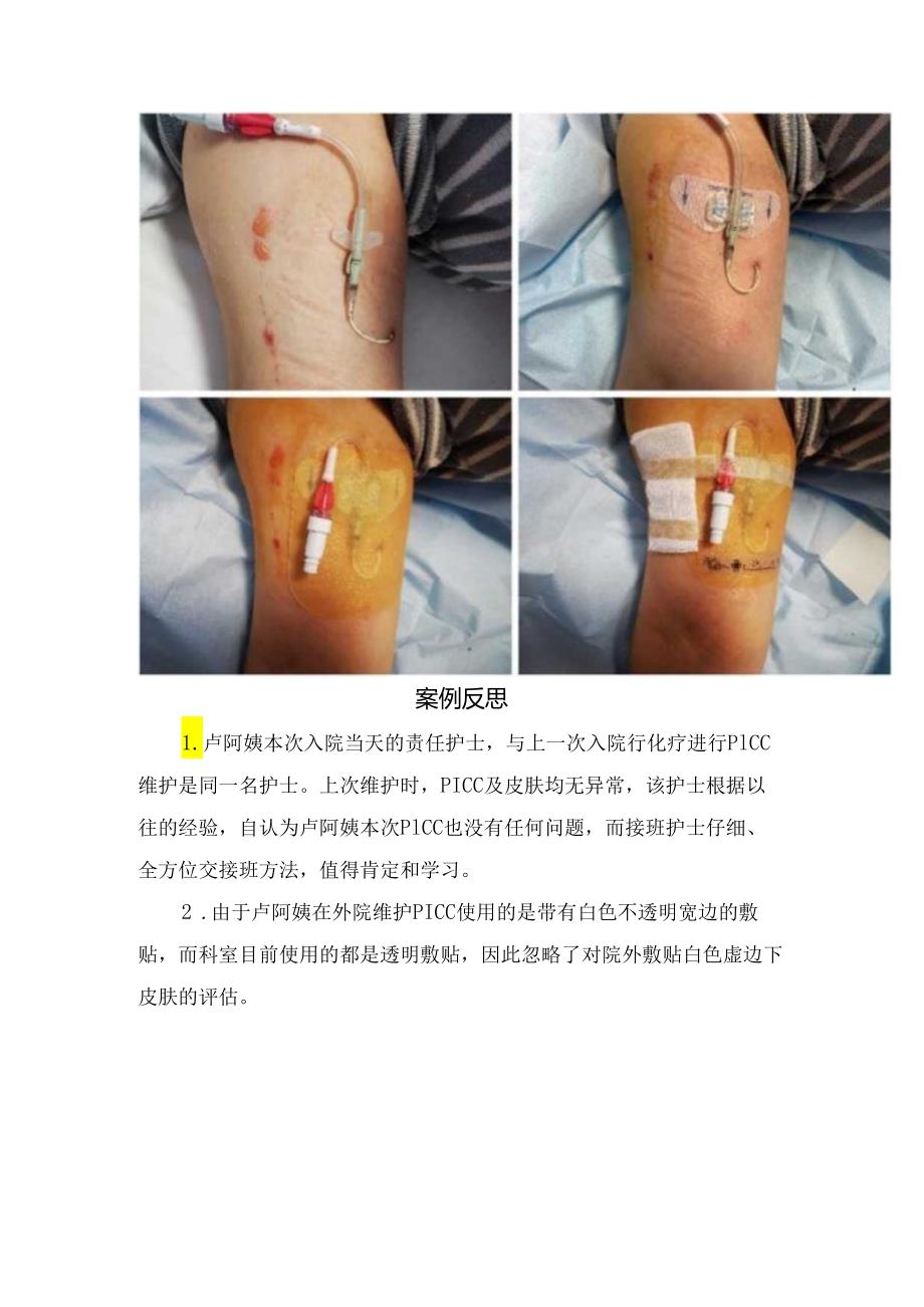 临床PICC患者护理交班接时发现隐藏问题案例分享.docx_第2页