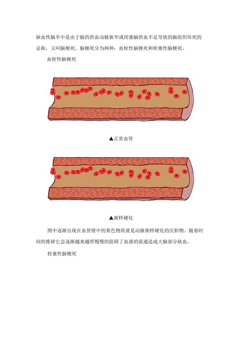 临床卒中疾病病理、分类、临床表现及卒中原则.docx_第3页